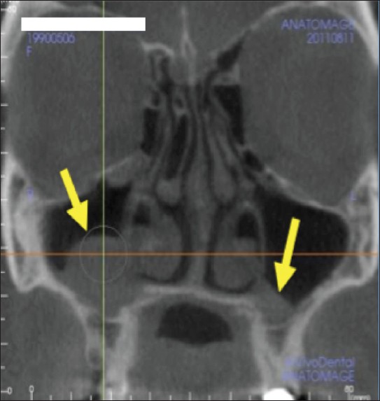 Figure 1: Sinus– mucosal thickening in maxillary sinus