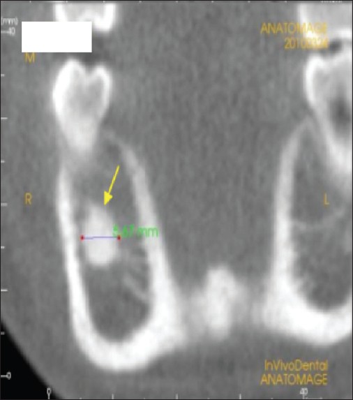 Figure 2: Dentoalveolar– focal sclerosis