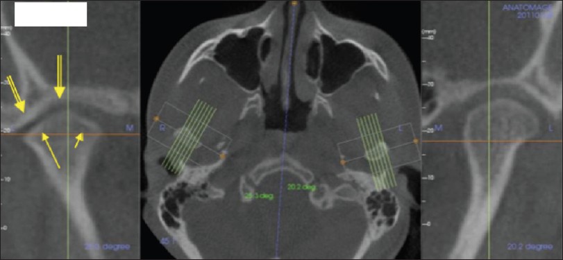 Figure 4: Flattening of the contour of the right condyle near both the lateral and medial poles (small arrows) in the oblique coronal image. Narrowing of the joint space (double arrows)