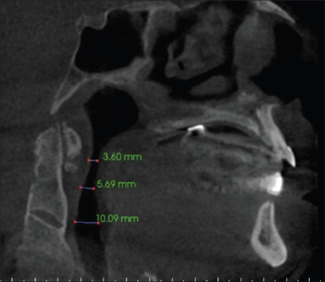 Figure 5: Fusion of the anterior and posterior borders of C2 and C3 vertebrae. The C3-C4 vertebral junction is not clearly visible since the vertebrae are on the edge of the scan fi eld of view