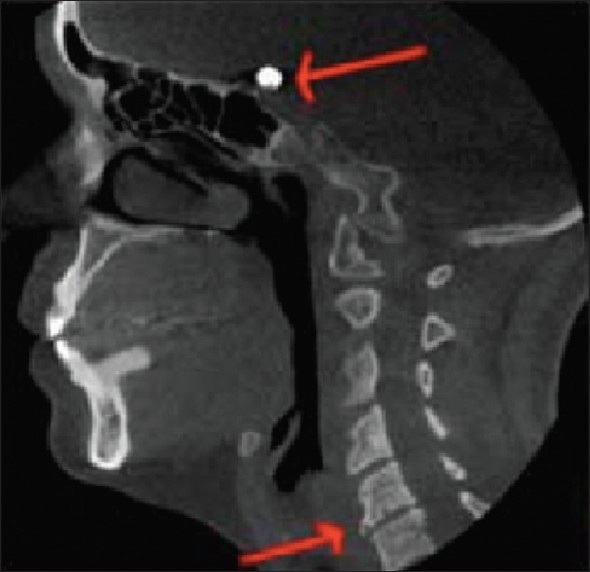 Figure 6: Osseous finding. Foreign object in anterior skull with degenerative change (vertebrae