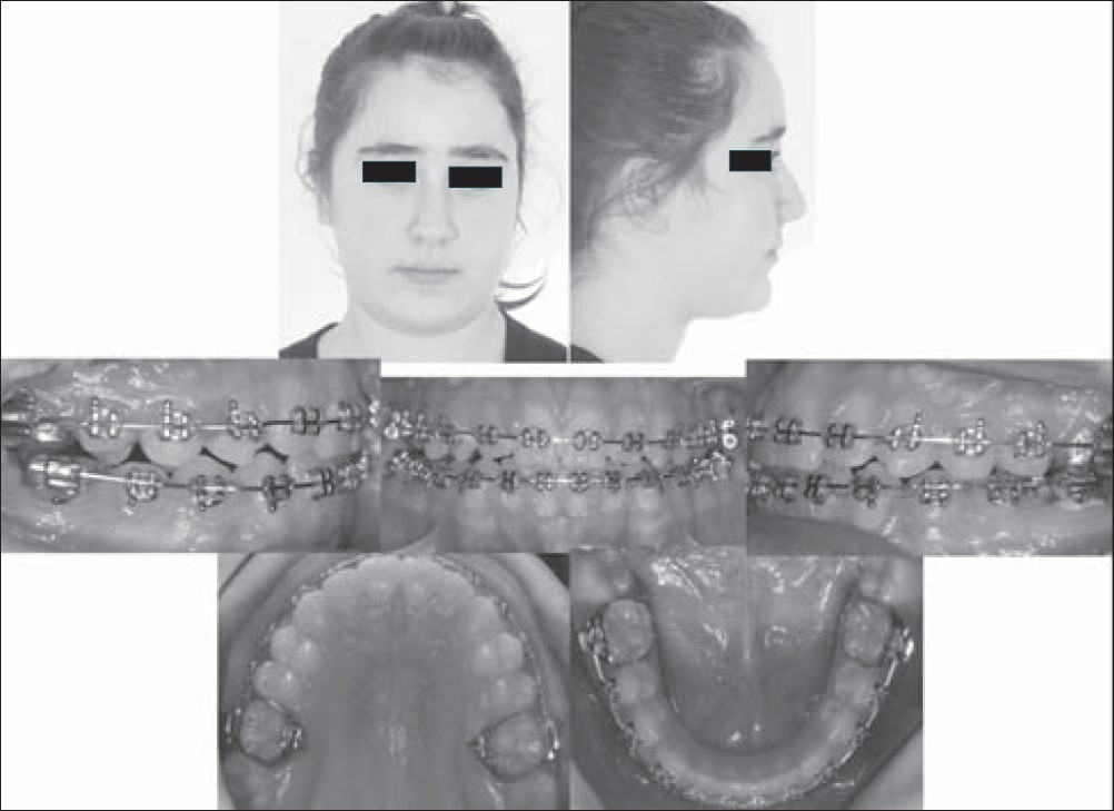 Figure 10: Intraoral and extraoral photographs of the patient at the end of sixth month of full fi xed therapy