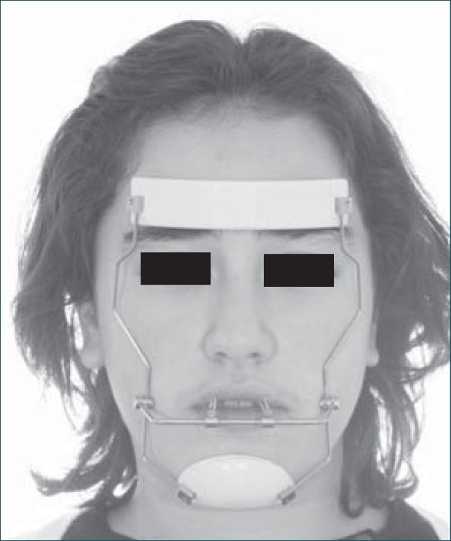 Figure 4: Facemask therapy with 30° elastic force traction to the occlusal plane
