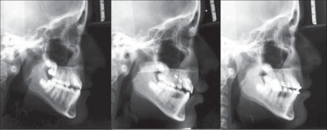 Figure 5: Lateral cephalograms of patient were taken prior to (T1) and at end of facemask therapy (T2), and after six months of full fixed orthodontic treatment (T3)