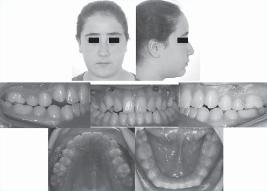 Figure 6: Intraoral and extraoral photographs of the patient at the end of facemask therapy