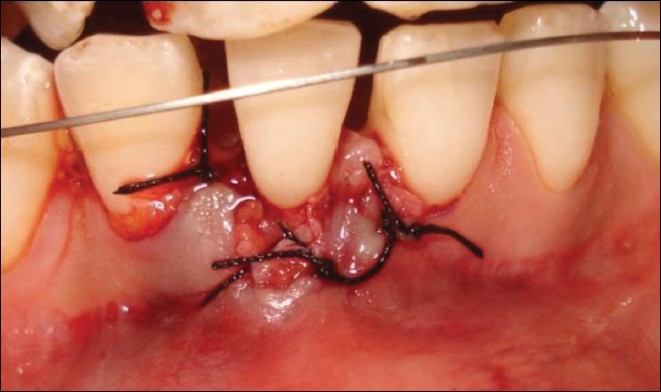 Figure 8: Subepithelial connective tissue graft secured with sling and interproximal sutures