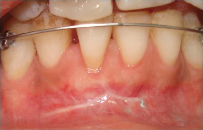 Figure 10: Partial root coverage obtained at 9 months following mucogingival surgery
