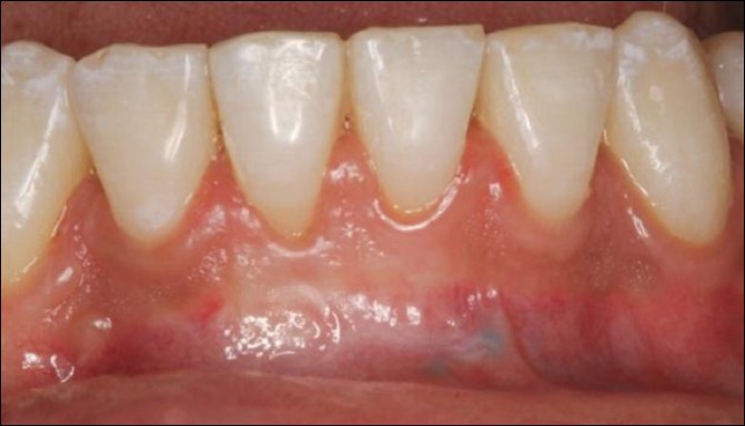 Figure 11: Completion of the orthodontic therapy. Note the minor amount of gingival recession