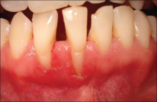 Figure 1: A Miller Class 3 gingival recession at teeth #41 and 42