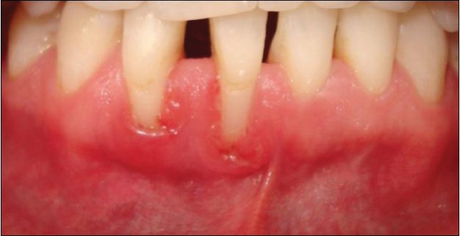 Figure 2: Clinical view after initial periodontal therapy (scaling and root planning + oral hygiene instruction)