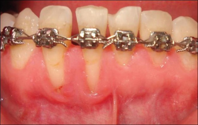Figure 3: Seven months at segmental orthodontic treatment before subepithelial connnective tissue grafting. Note the increase in the amount of recession at tooth 42
