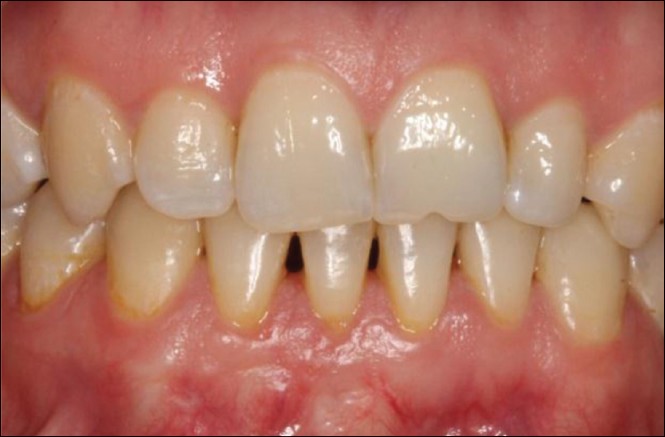 Figure 5: The final intraoral view at 33 months???