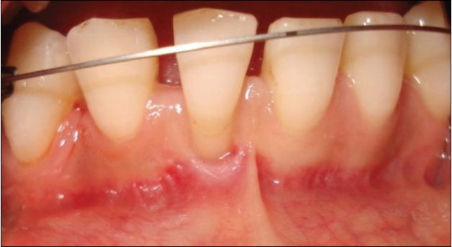 Figure 6: A Miller Class 2 gingival recession at tooth #41. Note the absence of mid-buccal keratinized tissue. Prior to anterior bracket placement after canine distalization