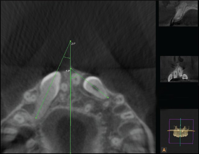 Figure 4: Axial view showing the angulation of bilaterally impacted canines to the midsagittal plane