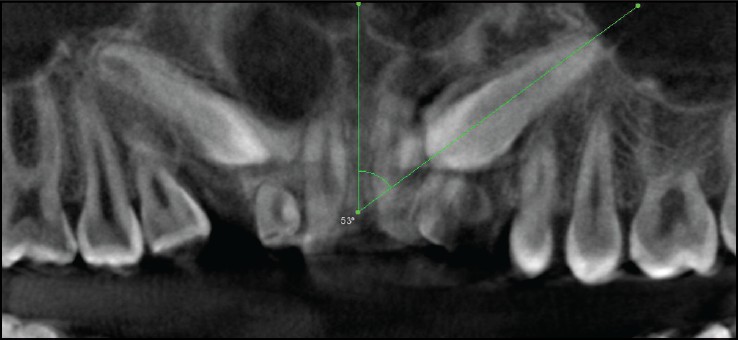 Figure 5: Sagittal view of the same patient considered for comparison of the angulation to the midsagittal plane