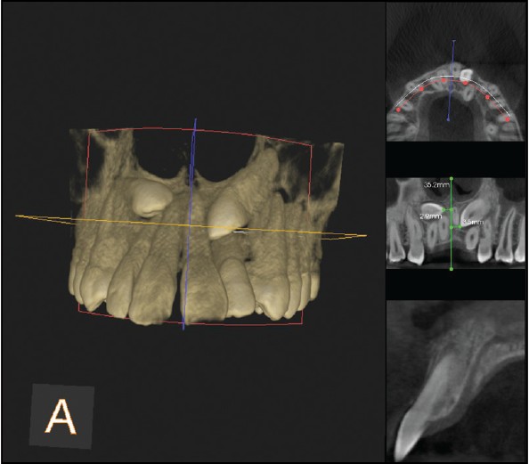Figure 6: 3D reconstructed image with clear demarcation of cuspal tip of impacted canines in anteroposterior direction