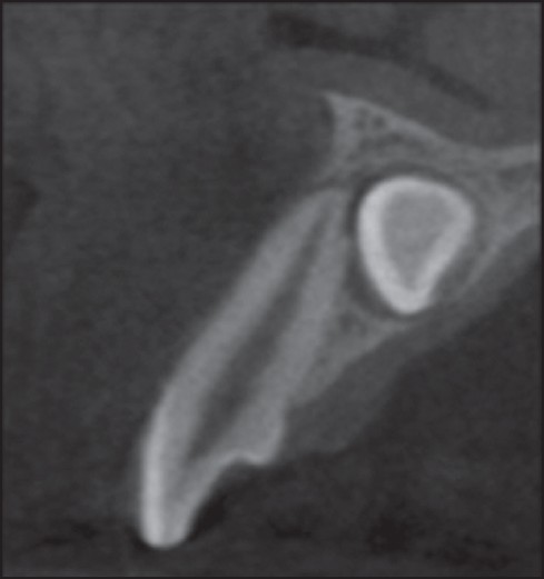 Figure 7: Sagittal view showing the resorption of root of the adjacent incisor at the apical third