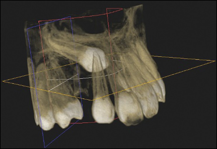 Figure 1: Three-dimensional (3D) reconstructed image of maxillary impacted canine using Kodak 9000