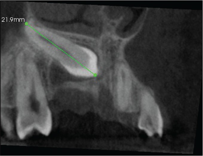 Figure 2: A CBCT image showing line connecting the long-axis of impacted maxillary canine