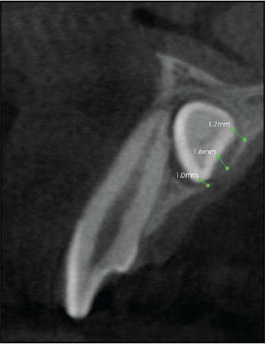Figure 3: Sagittal image showing the width of alveolus at different sites depending upon the site of impaction