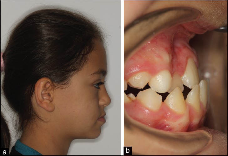 Figure 3: A female patient with skeletal and dentoalveolar Class III malocclusion before treatment (a) face and (b) dentition