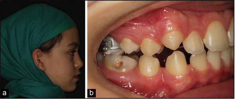 Figure 4: Last situation after treatment for (a) face and (b) dentition
