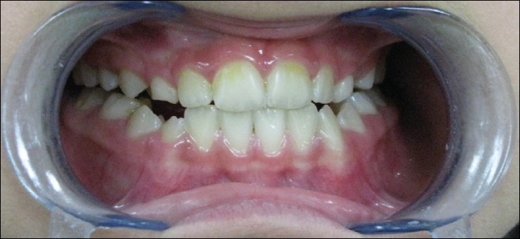 Figure 5: Post-treatment intraoral view