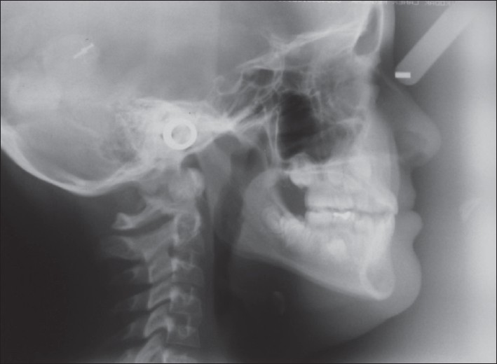 Figure 6: Post-treatment lateral cephalogram