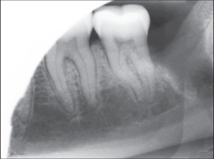 Figure 4: Periapical radiograph following surgical extraction