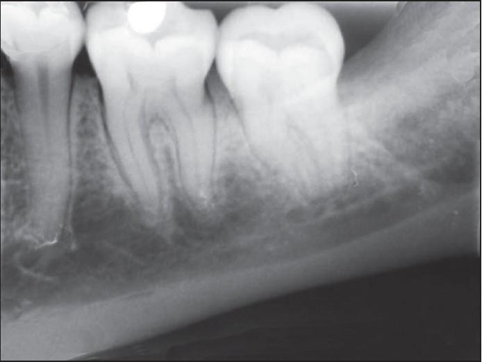 Figure 5: Periapical radiograph showing bone healing after 6-months follow-up