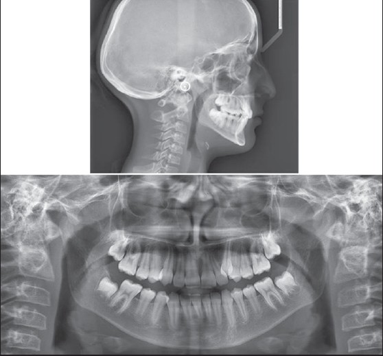 Figure 3: Pre-treatment lateral cephalogram and panoramic radiographs