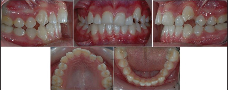 Figure 5: Intermediate intraoral photographs after obtaining space