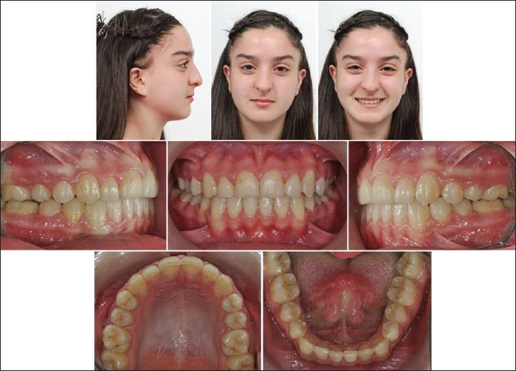 Figure 7: Post-treatment facial and intraoral photographs