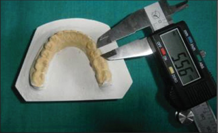 Figure 1: Measurement process of the mesiodistal tooth size