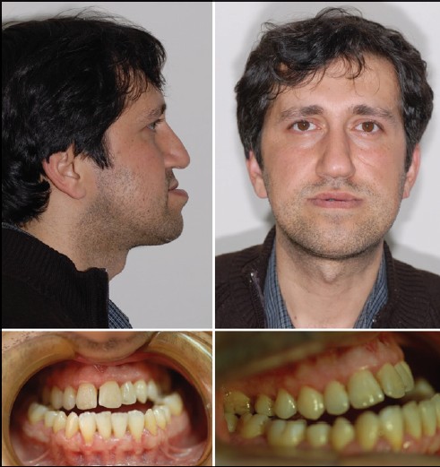 Figure 1: Extraoral and intraoral photos of the patient before treatment