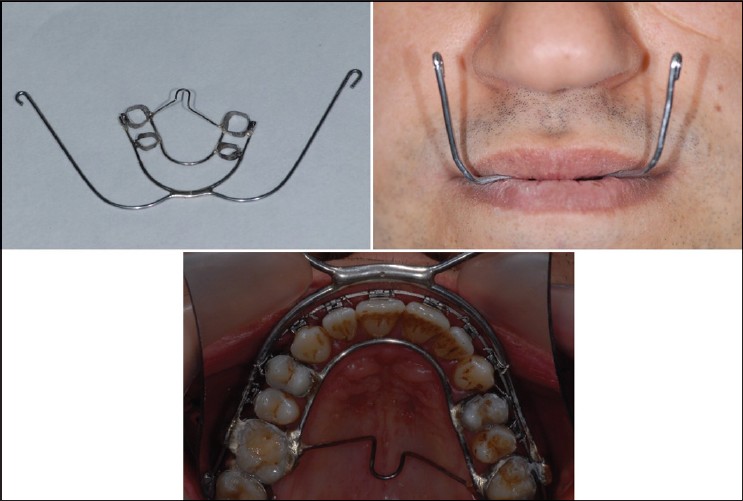 Figure 2: Intraoral part of rigid external distraction system