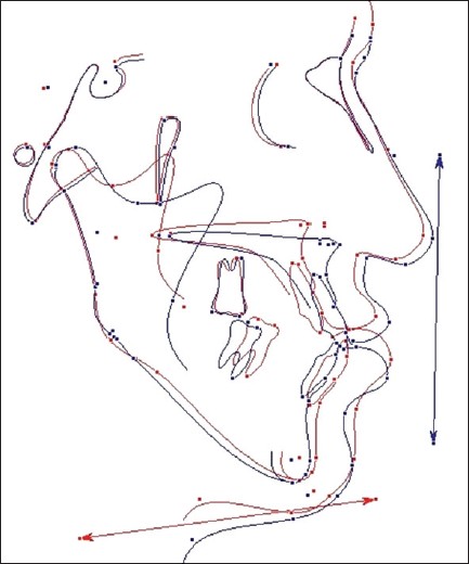 Figure 4: Superimposition of pre-and post-treatment lateral cephalometric tracings. Red colored line represents pre-treatment lateral cephalometric tracing and blue colored line represents post-treatment cephalometric tracing, 6 months after removal of rigid external distraction device