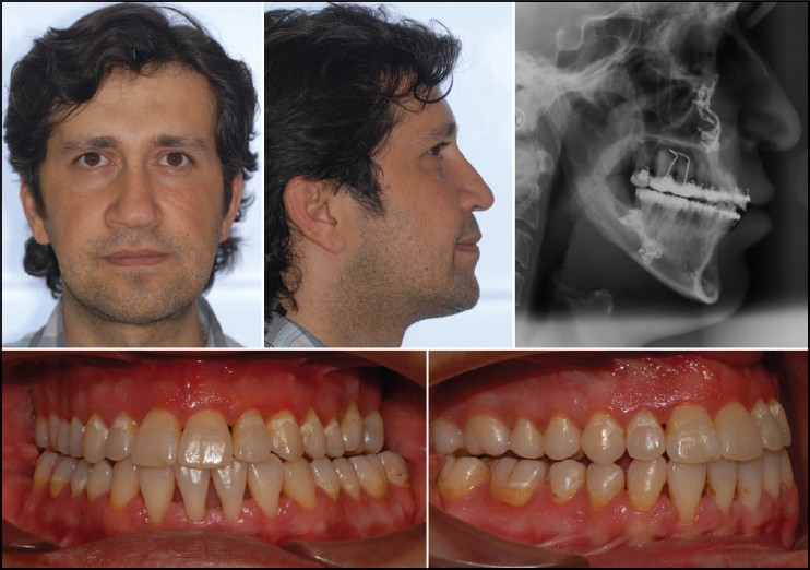 Figure 5: Extraoral and intraoral view of patient after treatment