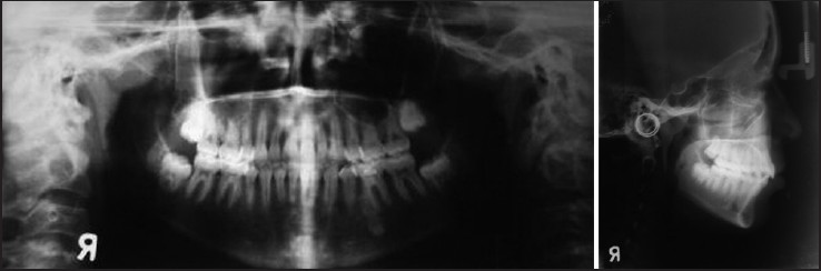 Figure 8: Radiographs after 2 years of treatment