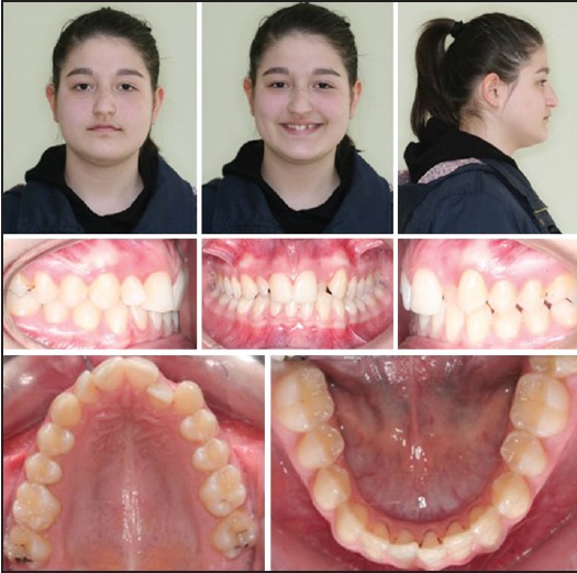 Figure 1: Pre-treatment extra- and intra-oral photographs of the patient