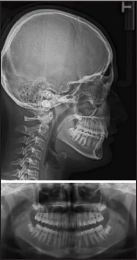 Figure 2: Pre-treatment radiographs of the patient