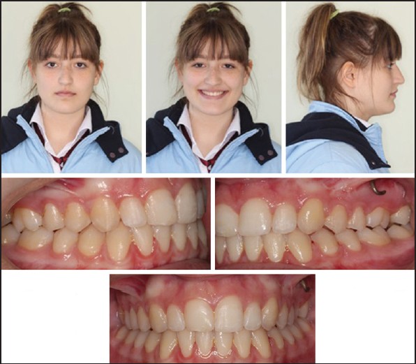 Figure 5: Extra- and intra-oral photographs of the patient after debonding