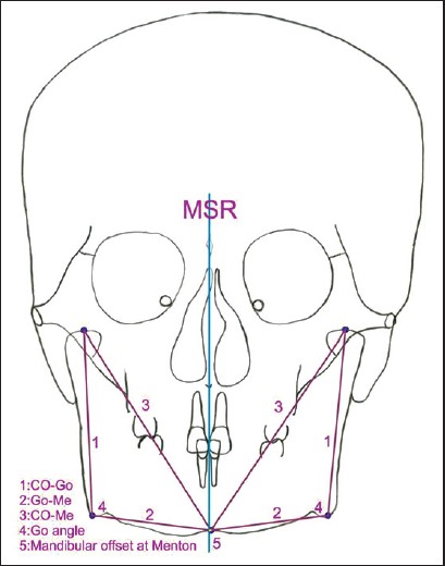 Figure 4: Mandibular morphology and mandibular deviation