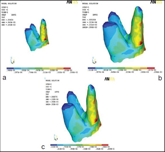 Figure 11: von-mises stress contours in periodontal ligament (a) at 150 g force (b) at 180 g force (c) at 210 g force
