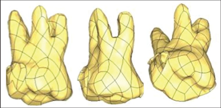 Figure 3: Three-dimensional model of maxillary molar using mimic software
