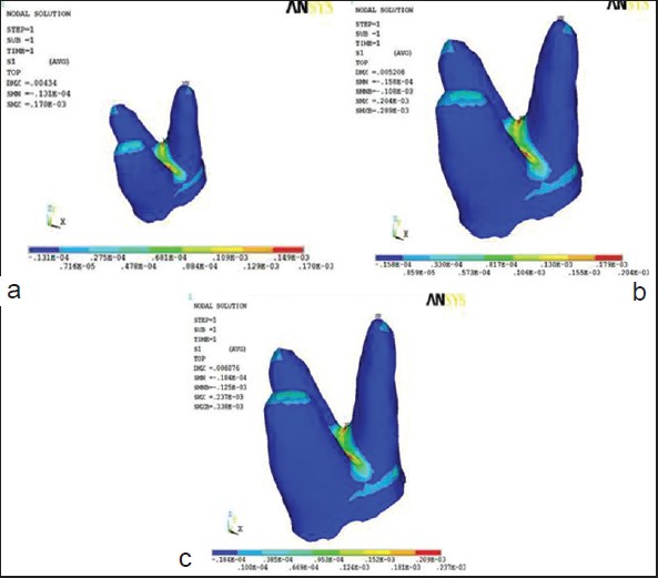 Figure 8: Maximum principal stress contours in periodontal ligament (a) at 150 g (b)180 g and (c) 210 g