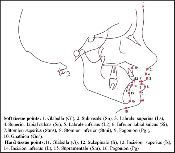 Figure 1: Cephalometric points and landmarks used in the study