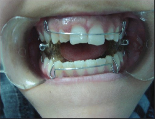 Figure 2: Intraoral photograph of the modified bionator