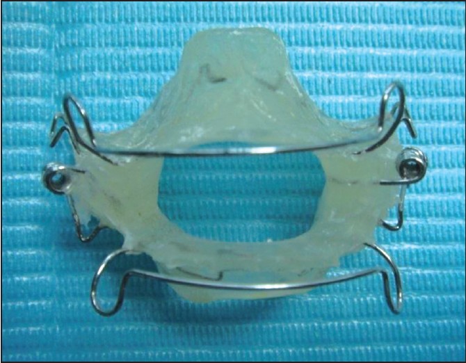 Figure 3: Extraoral photograph of the modified bionator, the lingual and palatal arches were replaced by acrylic