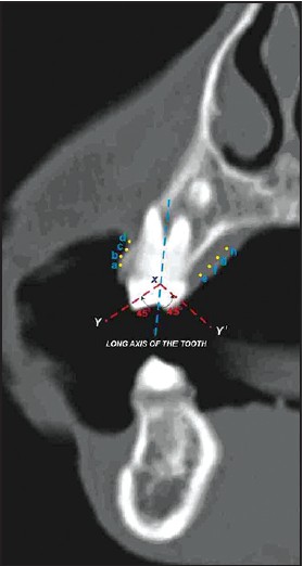 Figure 3: Coronal section view in computed tomography with buccal and palatal points marked at different levels for soft-tissue thickness